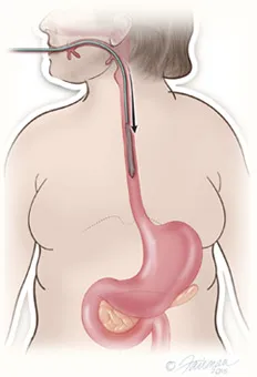 Gastric balloon placement diagram step 1