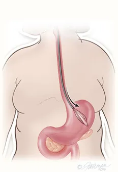 Gastric balloon placement diagram step 2
