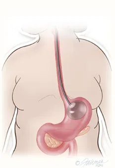 Gastric balloon placement diagram step 3