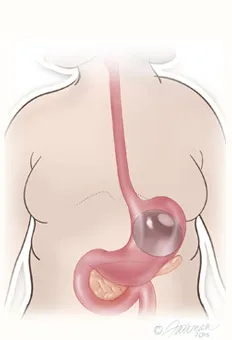 Gastric balloon removal diagram step 1