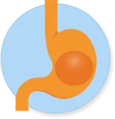 Gastric balloon in stomach