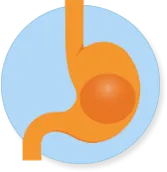 Gastric Balloon in stomach