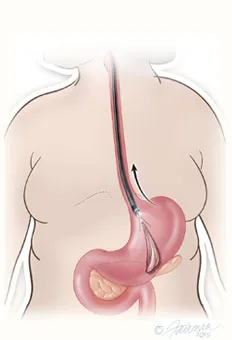 Gastric balloon removal diagram step 2