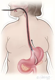 Gastric balloon removal diagram step 3